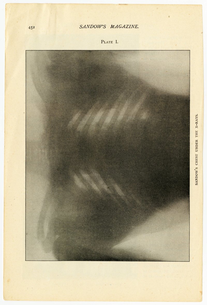 Sandow's chest under the X-rays
